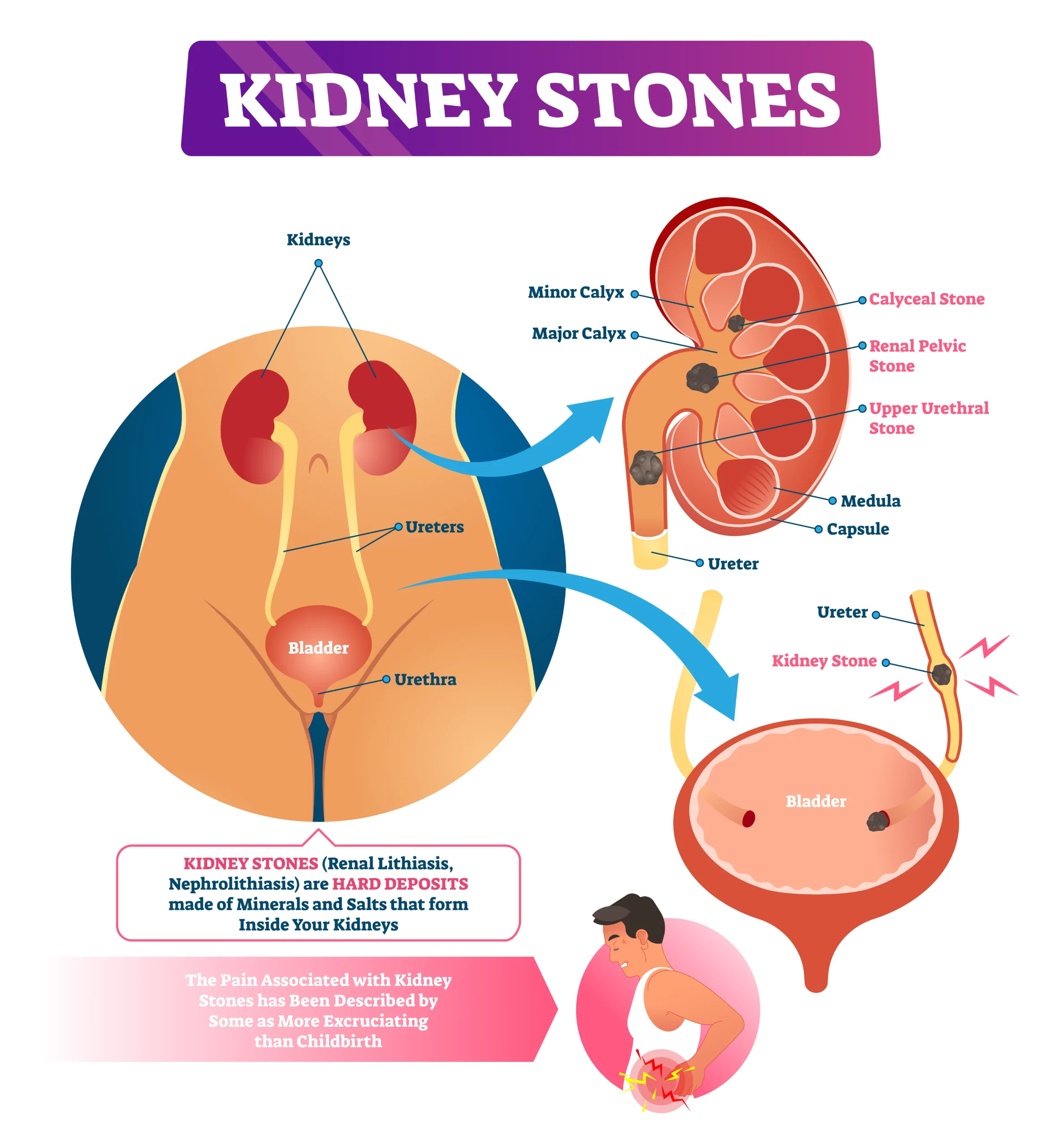 kidney stones pain