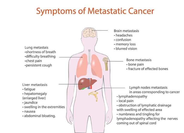 All You Need to Know About Sarcoma - CK Birla Hospital