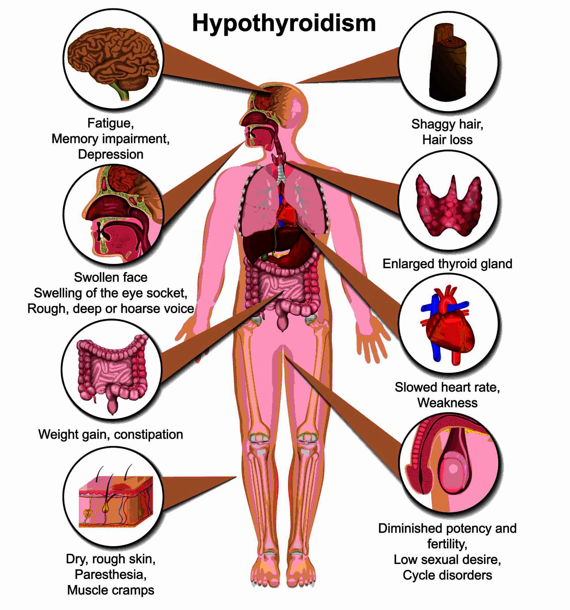 hypothyroidism-causes-symptoms-diagnosis-and-treatment-ck-birla