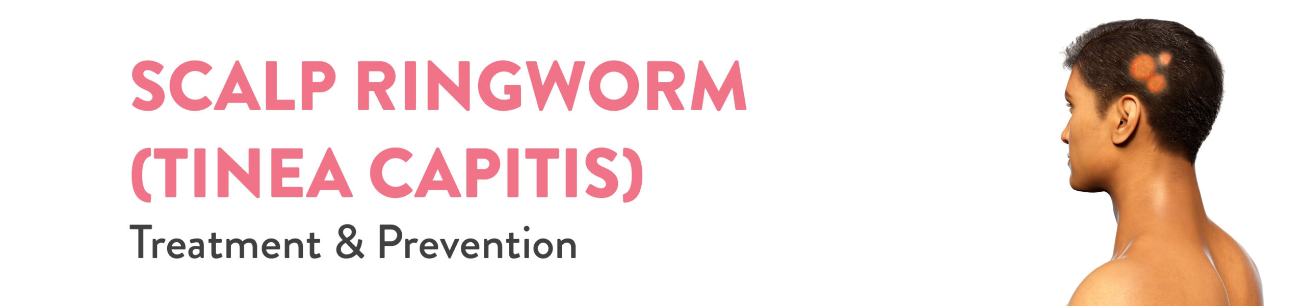 ringworm prevention