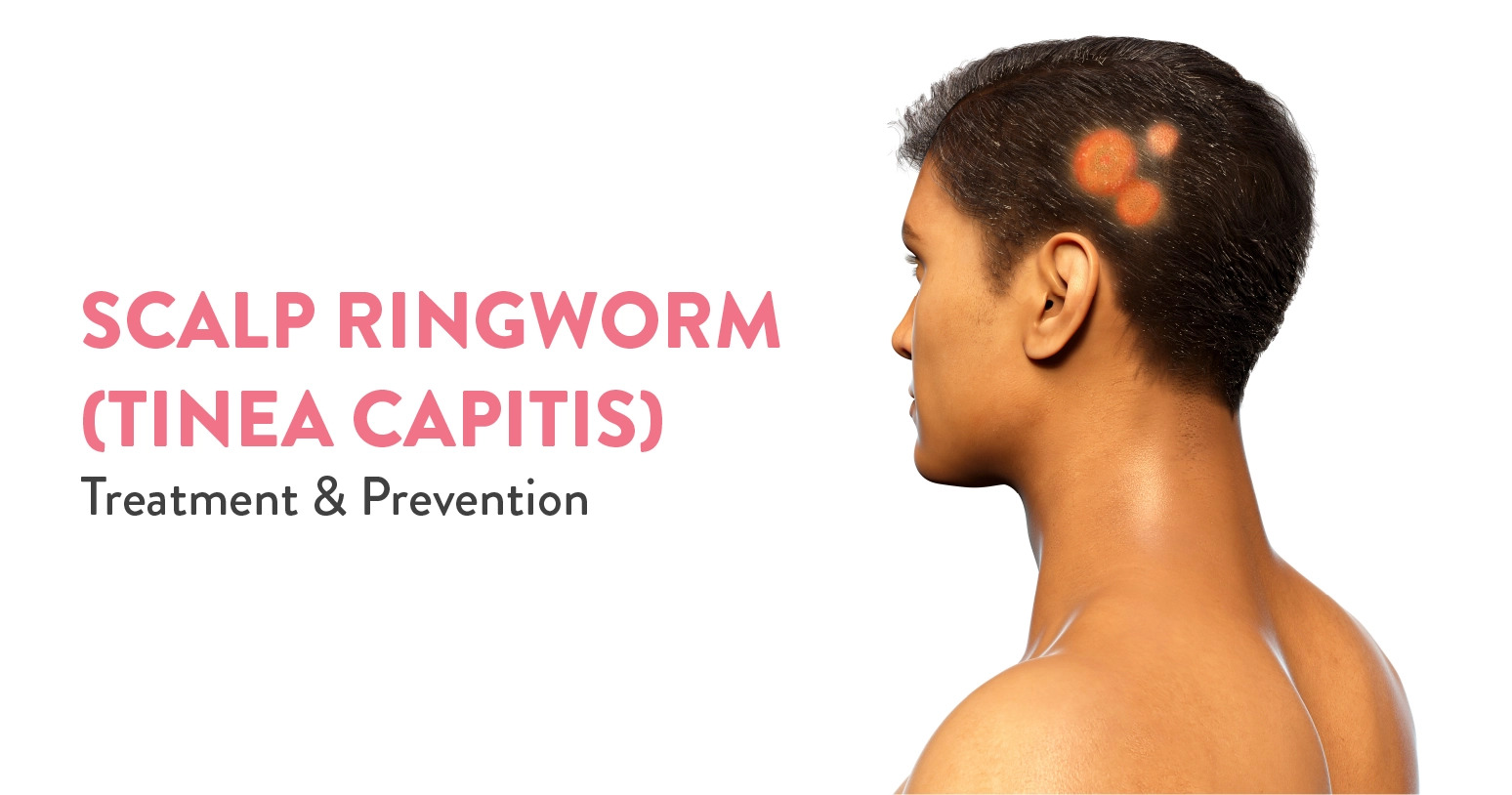 Suffering From Scalp Ringworm (Tinea Capitis): Know Its Treatment &  Prevention