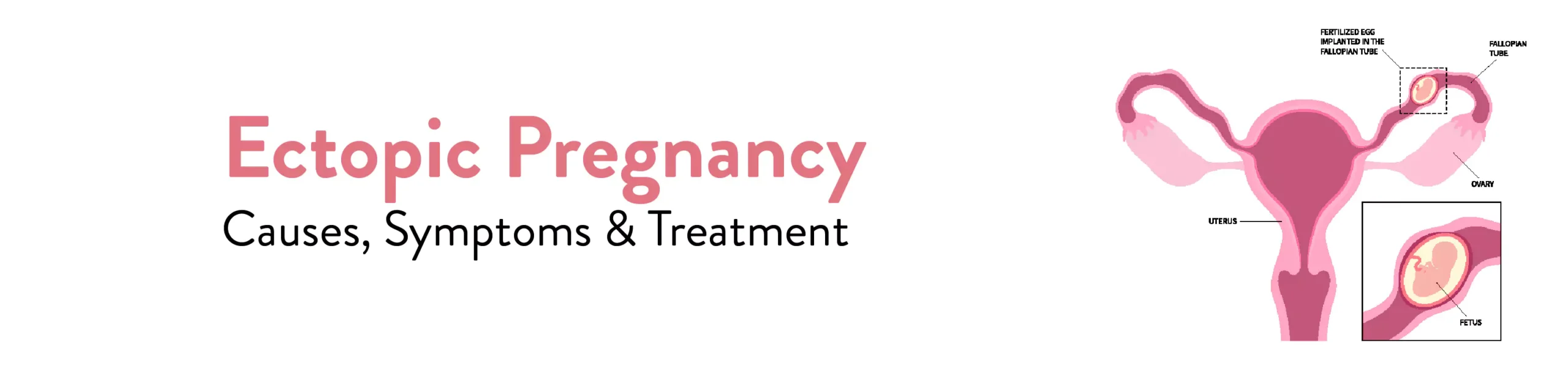 ectopic pregnancy causes symptoms and treatment