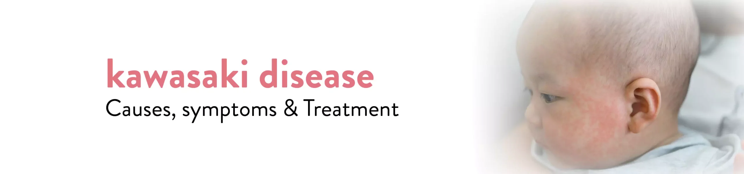 kawasaki-disease-causes-symptoms and treatment